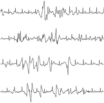 Identification of Transient Noise to Reduce False Detections in Screening for Atrial Fibrillation